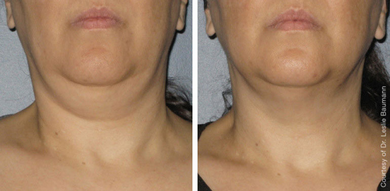 before / after: treatment double chin
