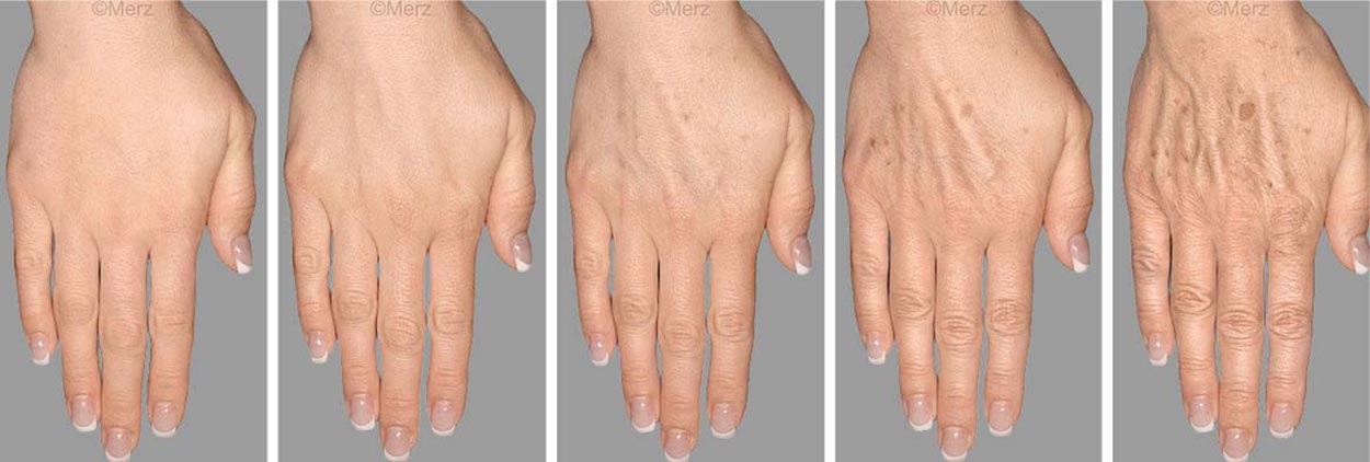 Visible signs of skin aging on the hands