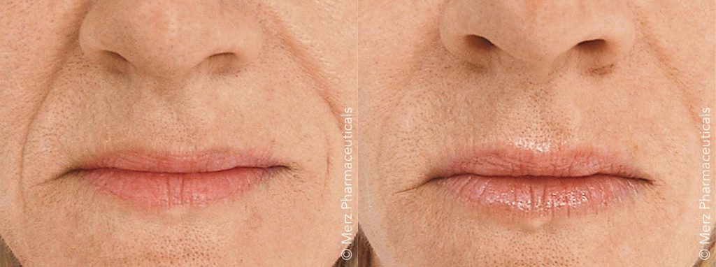 Reduction of the nasolabial folds