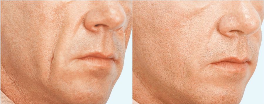 Lifting of the chin line by volume augmentation, wrinkle reduction